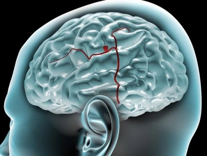 Embolização de Aneurisma Cerebral