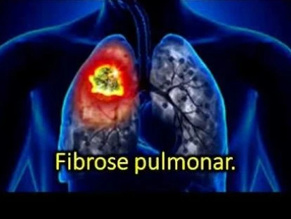 Nintedanibe deve ser fornecido pelo plano de saúde 