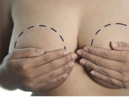 Hipertrofia mamária