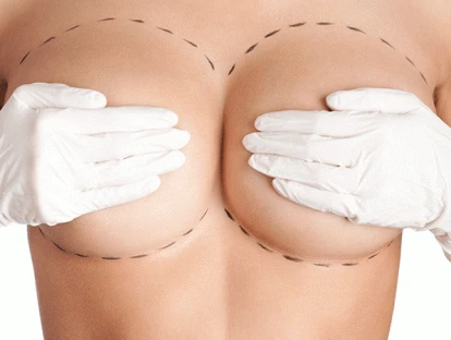 Mamoplastia redutora