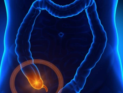 Erro de Diagnóstico - Apendicite