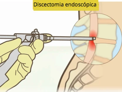 DISCECTOMIA ENDOSCÓPICA