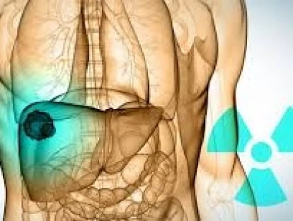 Radioterapia estereotáxica