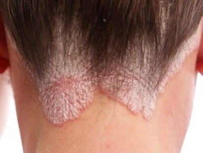 Cosentyx: planos de saúde e SUS devem custear? Veja!