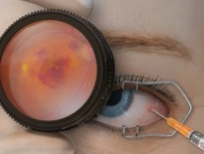 Lucentis para pseudoxantoma elástico e estrias angóides