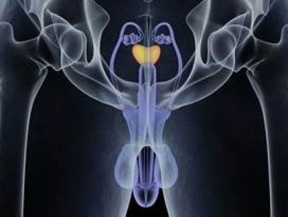 Prostatectomia Radical Laparoscópica Robótica