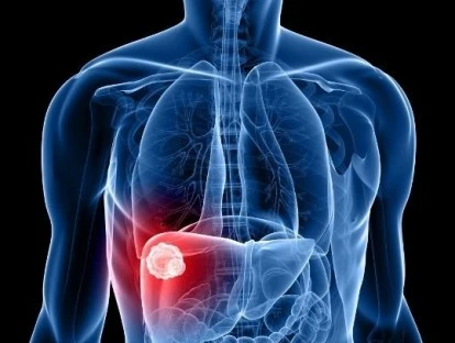 Pemetrexede (Alimta) pelo plano de saúde ou SUS: entenda!