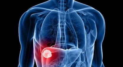 Pemetrexede (Alimta): quando o plano de saúde ou o SUS devem fornecer o medicamento?
