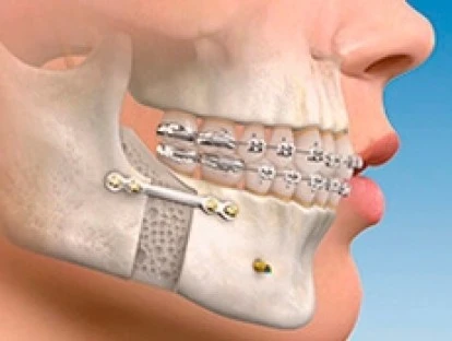 Plano de saúde não pode intervir na prescrição do médico e alterar material de cirurgia buco-maxilo-facial