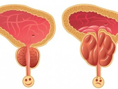 Vaporização fotoseletiva da próstata pelo plano de saúde: é possível?