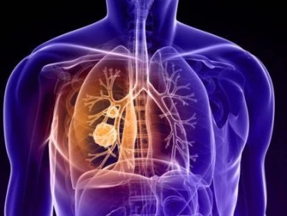 OSIMERTINIBE - TRAGRISSO