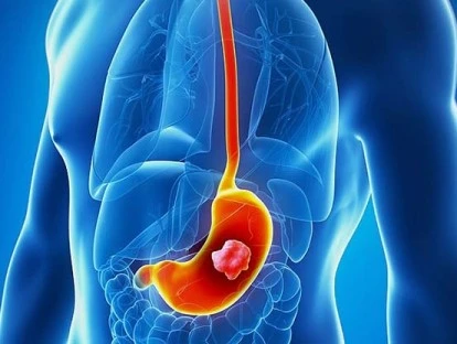 Medicamento Cyramza (ramucirumabe)