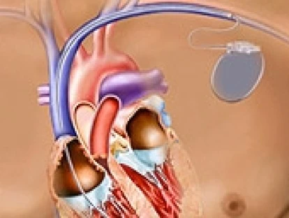 Aparelho cardiodesfibrilador DDD