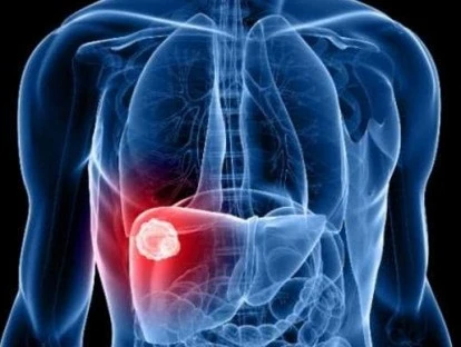 Portador de hepatite C crônica 