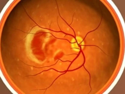Tratamento ocular quimioterápico