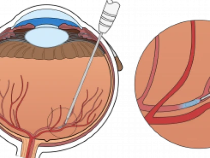 Tratamento intravítreo com antiangiogênico Lucentis