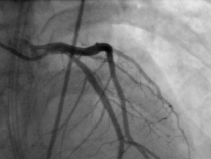 Exame de cateterismo cardíaco - cineangiocoronariografia - pelo plano de saúde