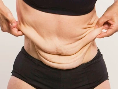 Plano de saúde é condenado a pagar dermolipectomia e mastopexia 