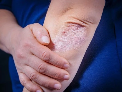 Otezla - Apremilaste