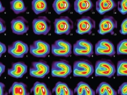 Cintilografia de corpo inteiro com 18-FDG
