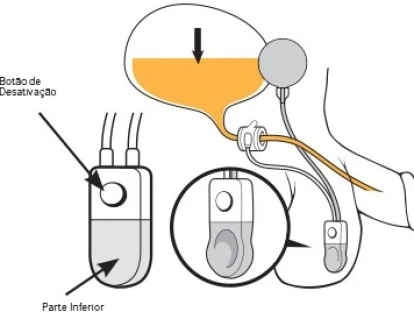 Plano de saúde deve custear esfíncter artificial e sling? Veja!