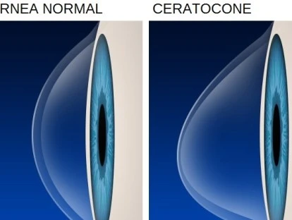 Ceratocone