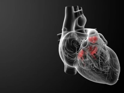  Implante de transcateter da prótese aórtica Sapien 3