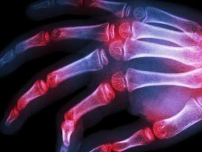 Tocilizumabe (Actemra)