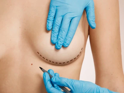 Mastectomia masculinizadora pelo plano de saúde: valor, cobertura e informações sobre a cirurgia