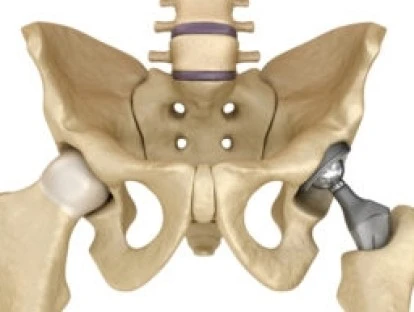 Cirurgia de artroplastia e materiais cirúrgicos