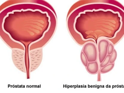 Tratamento de embolização da próstata