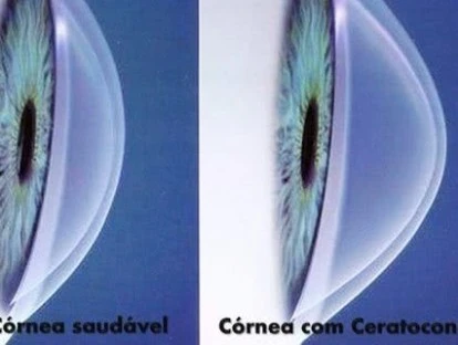 Plano de saúde é condenado a custear cirurgia Crosslinking para tratar ceratocone