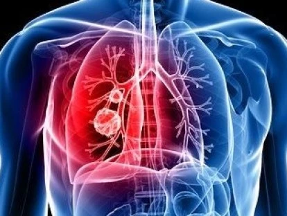 Medicamento Zykadia (ceritinib)