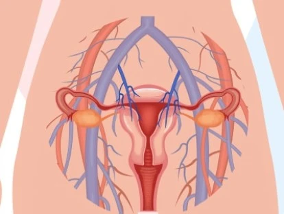 Embolização de varizes pélvicas: plano de saúde deve custear tratamento