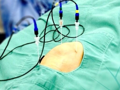 Rizotomia de facetas articulares