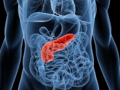 Oxalibbs (oxaliplatina)