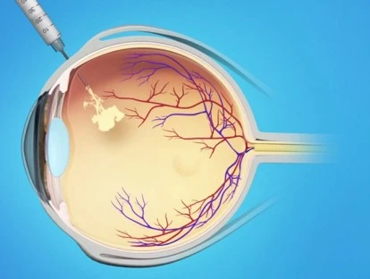 Tratamento oftalmológico com Lucentis