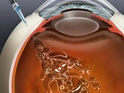 Retinopatia diabética