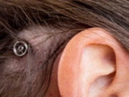 BAHA: plano de saúde deve custear implante auditivo? Veja!