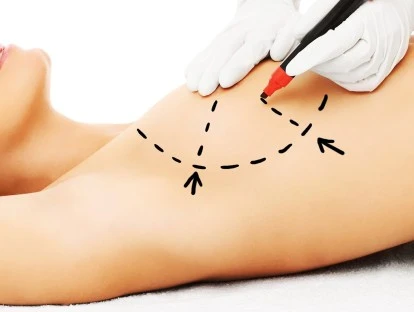 Plano de saúde deve custear cirurgia de hipertrofia mamária após gastroplastia