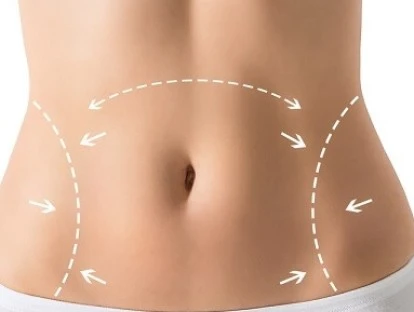 Dermolipectomia abdominal não estética pelo plano de saúde: entenda!