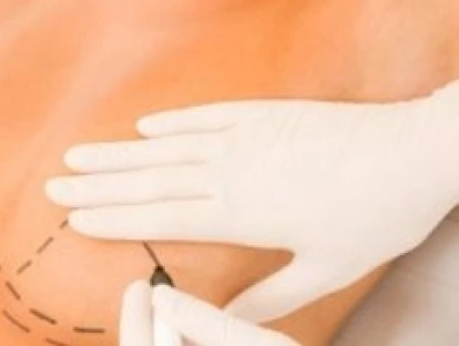 Redução das mamas por hipertrofia mamária: plano de saúde deve custear cirurgia