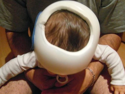 Plano de saúde deve pagar capacete a bebê com plagiocefalia 