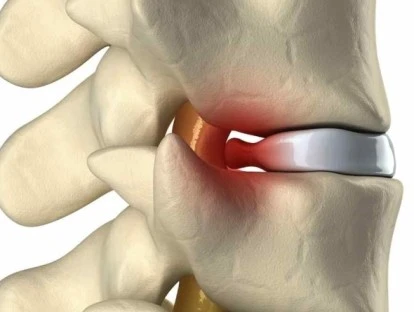 Plano deve cobrir hidroterapia para espondilodiscopatia degenerativa com hérnias discais na coluna lombar