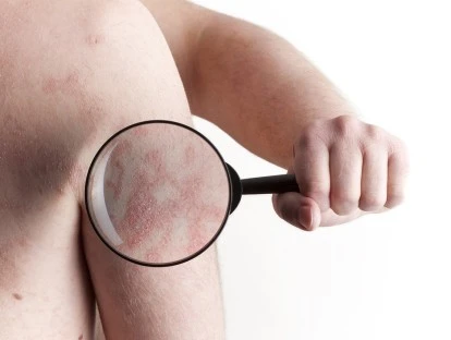 Otezla (apremilaste): planos de saúde e SUS devem fornecer