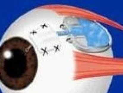  Implante valvular de Ahmed