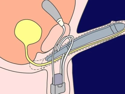 Prótese peniana inflável: plano de saúde é obrigado a custear tratamento