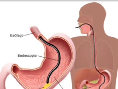 Biópsia por ecoendoscopia: plano de saúde deve custear procedimento