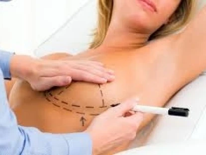  Retirada de pele nas mamas e prótese após bariátrica