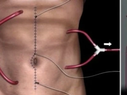 Quimioterapia hipertermica